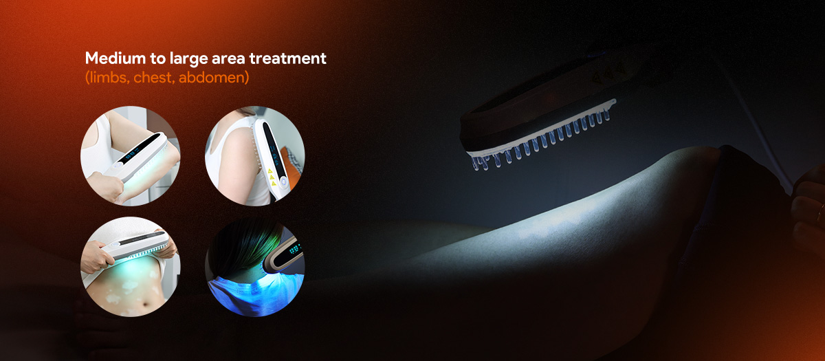 Handheld UVB therapy on leg