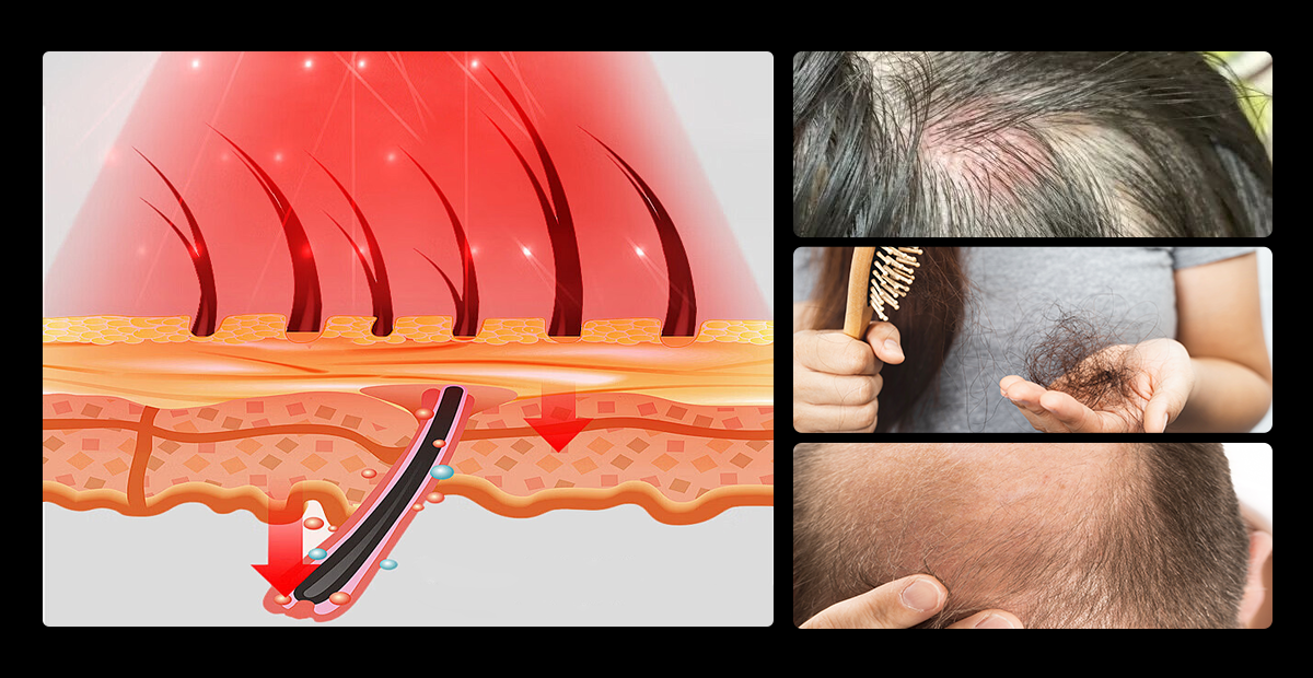 Hair Regrowth